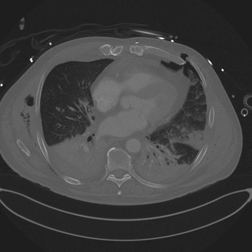 Cardiac trauma (Radiopaedia 32874-33858 Axial bone window 55).jpg