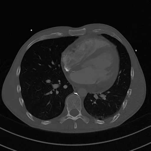 File:Cardiac tumor - undifferentiated pleomorphic sarcoma (Radiopaedia 45844-50134 Axial bone window 42).png