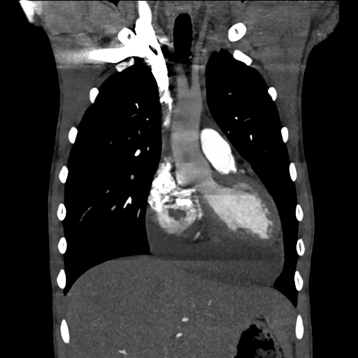 Cardiac tumor - undifferentiated pleomorphic sarcoma (Radiopaedia 45844-50134 Coronal non-contrast 23).png