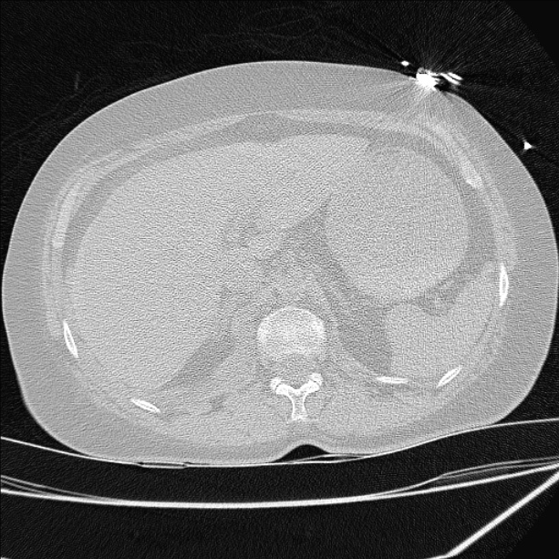 Cardiogenic pulmonary edema (Radiopaedia 29213-29609 Axial lung window 109).jpg