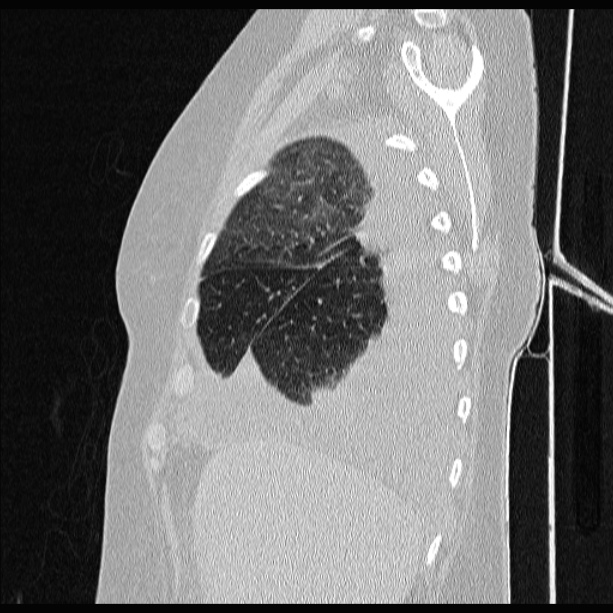 Cardiogenic pulmonary edema (Radiopaedia 29213-29609 Sagittal lung window 19).jpg