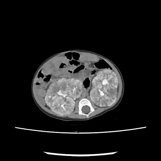 Caroli disease with autosomal recessive polycystic kidney disease (ARPKD) (Radiopaedia 89651-106703 E 128).jpg