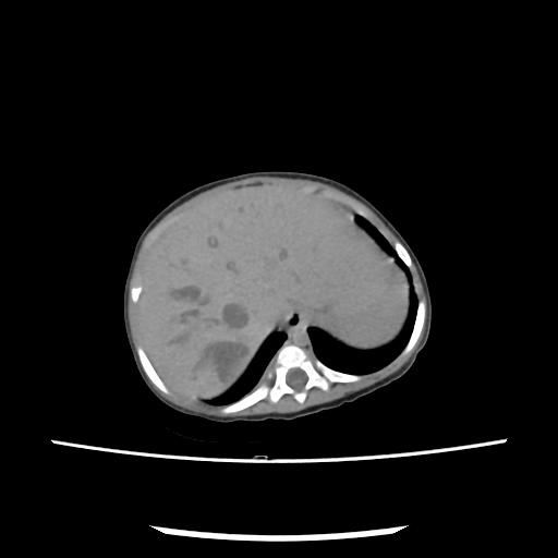 Caroli disease with autosomal recessive polycystic kidney disease (ARPKD) (Radiopaedia 89651-106703 E 32).jpg