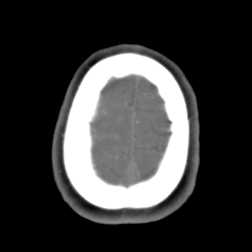 Carotico ophthalmic aneurysm (Radiopaedia 42916-46148 A 8).png