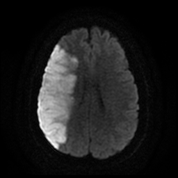 File:Carotid arterial dissection with acute cerebral infarction (Radiopaedia 26636-26784 Axial DWI 14).jpg