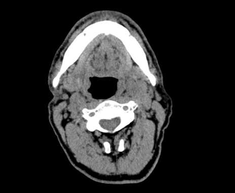 Carotid body tumor (Radiopaedia 61750-69757 Axial non-contrast 39).jpg