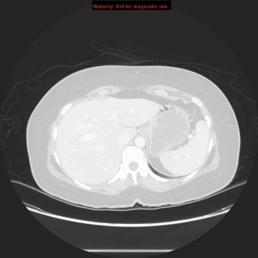 Carotid body tumor with lung metastases (Radiopaedia 9301-48390 Axial lung window 63).jpg