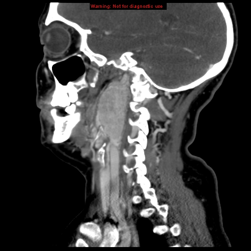 File:Carotid body tumor with lung metastases (Radiopaedia 9301-9986 Sagittal C+ delayed 34).jpg