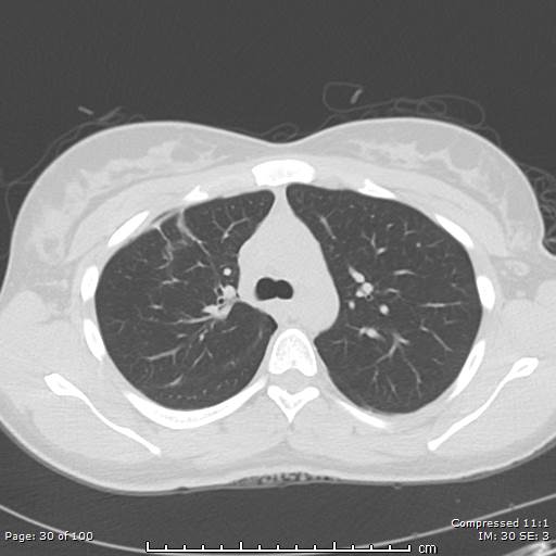 Catamenial pneumothorax (Radiopaedia 54382-60600 Axial non-contrast 30).jpg
