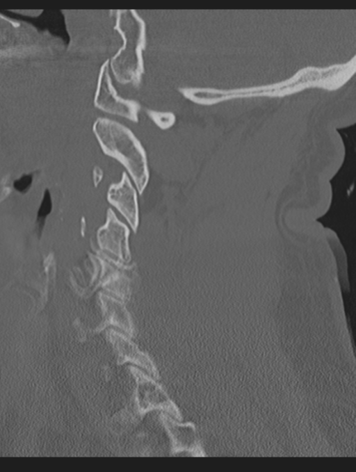 Cavernoma of cervical cord (Radiopaedia 50838-56346 Sagittal bone window 30).png