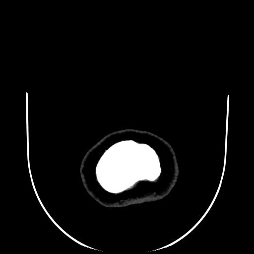 Cavernoma with developmental venous anomaly (Radiopaedia 22470-22506 C 206).jpg