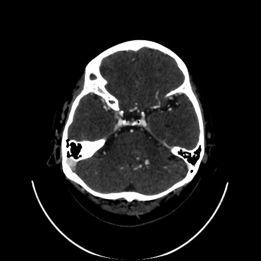 Cavernoma with developmental venous anomaly (Radiopaedia 22470-22506 C 37).jpg