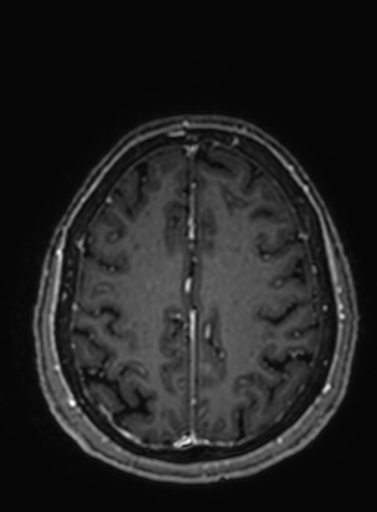 Cavernous hemangioma of the cerebellar falx (Radiopaedia 73025-83724 Axial T1 C+ 93).jpg