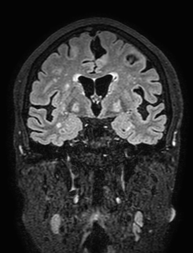 Cavernous hemangioma of the cerebellar falx (Radiopaedia 73025-83724 Coronal FLAIR 159).jpg