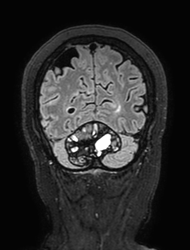 Cavernous hemangioma of the cerebellar falx (Radiopaedia 73025-83724 Coronal FLAIR 299).jpg