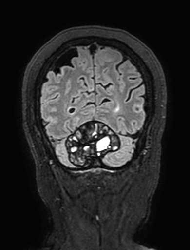 Cavernous hemangioma of the cerebellar falx (Radiopaedia 73025-83724 Coronal FLAIR 302).jpg