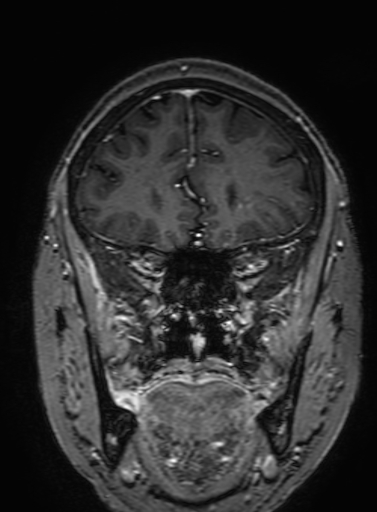 Cavernous hemangioma of the cerebellar falx (Radiopaedia 73025-83724 Coronal T1 C+ 107).jpg