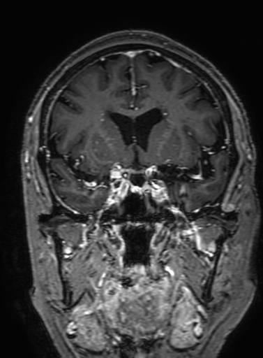 Cavernous hemangioma of the cerebellar falx (Radiopaedia 73025-83724 Coronal T1 C+ 147).jpg