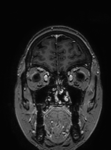 Cavernous hemangioma of the cerebellar falx (Radiopaedia 73025-83724 Coronal T1 C+ 65).jpg