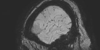 File:Cavernous hemangioma of the cerebellar falx (Radiopaedia 73025-83724 Sagittal BOLD 185).jpg