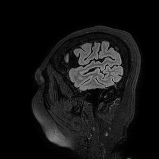 Cavernous hemangioma of the cerebellar falx (Radiopaedia 73025-83724 Sagittal FLAIR 16).jpg