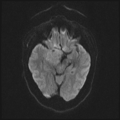 File:Cavernous sinus meningioma (Radiopaedia 63682-72367 DWI 50).jpg