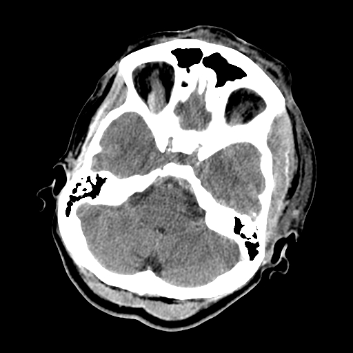 File:Cavernous sinus thrombosis (Radiopaedia 10619-11078 Axial non-contrast 11).jpg