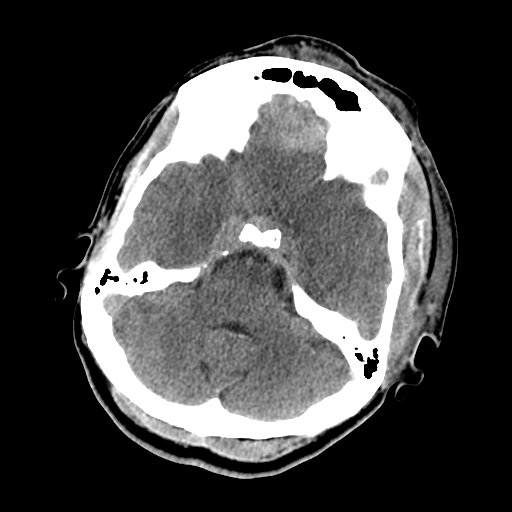 File:Cavernous sinus thrombosis (Radiopaedia 10619-11078 Axial non-contrast 13).jpg