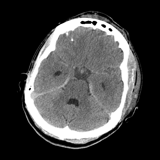 File:Cavernous sinus thrombosis (Radiopaedia 10619-11078 Axial non-contrast 15).jpg