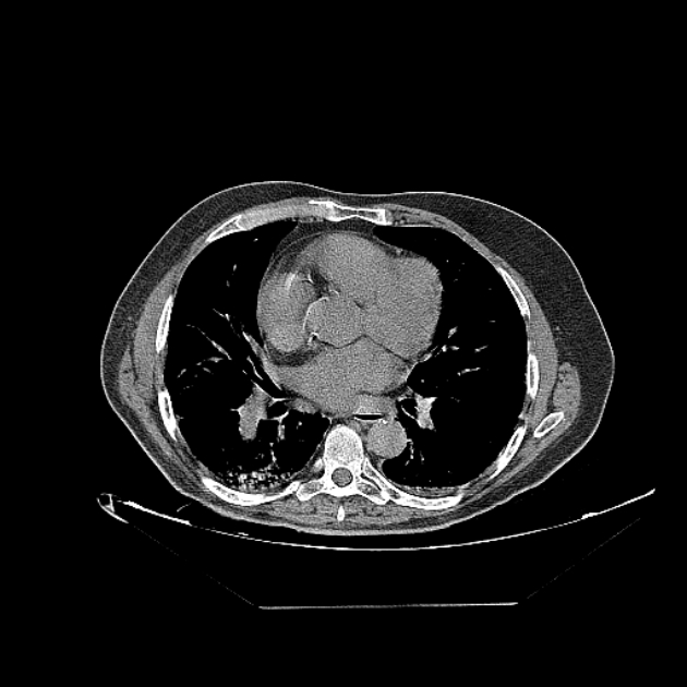 Cavitating bronchogenic carcinoma (Radiopaedia 44489-48162 Axial non-contrast 50).jpg