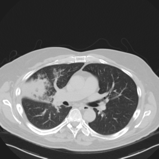 File:Cavitating pneumonia (Radiopaedia 45998-50329 Coronal lung window 1).png