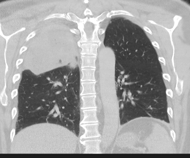 File:Cavitating pneumonia (Radiopaedia 45998-50329 Coronal lung window 34).png