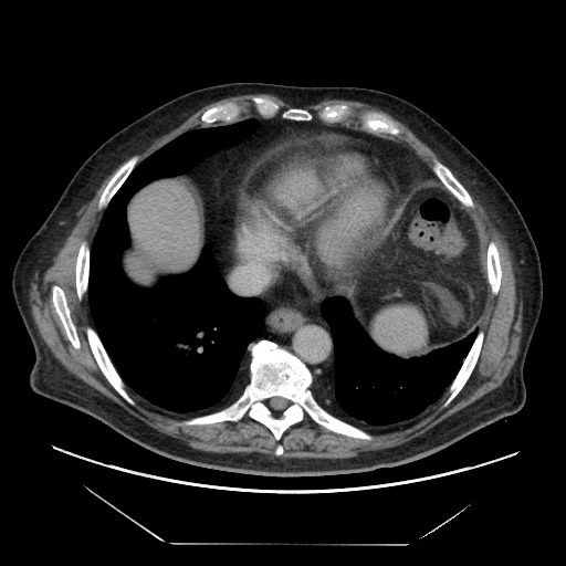 Cecal adenocarcinoma (Radiopaedia 64871-73817 A 5).jpg