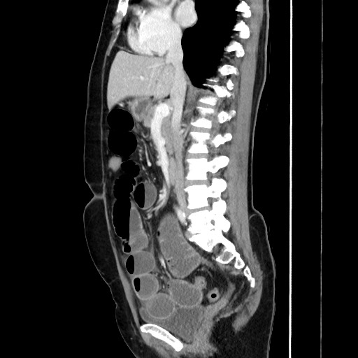 Cecal adenocarcinoma (Radiopaedia 75909-87331 C 35).jpg