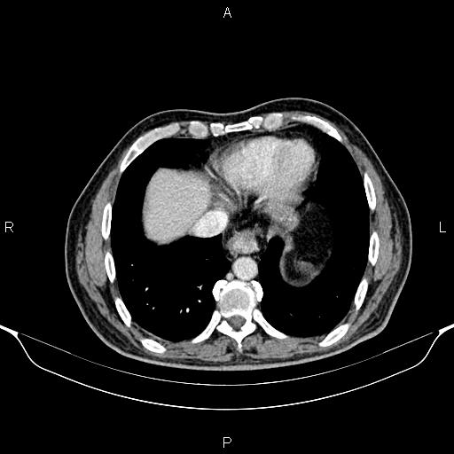 Cecal adenocarcinoma (Radiopaedia 85324-100916 B 8).jpg