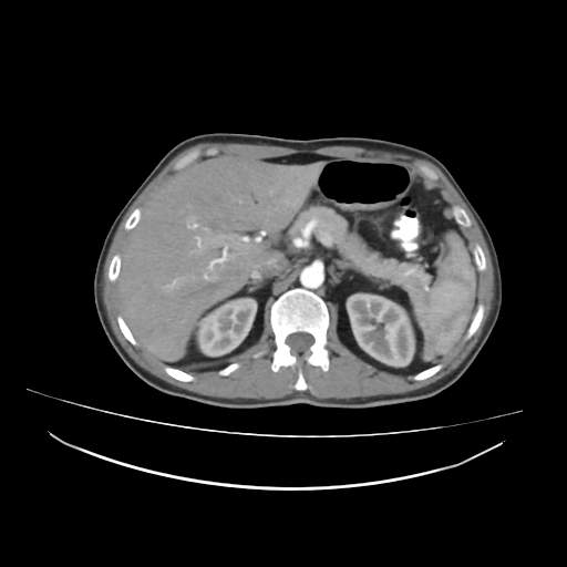 Cecal carcinoma with local lymphadenopathy (Radiopaedia 31428-32240 A 12).jpg