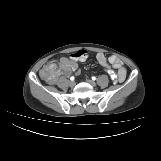Cecal carcinoma with local lymphadenopathy (Radiopaedia 31428-32240 A 36).jpg
