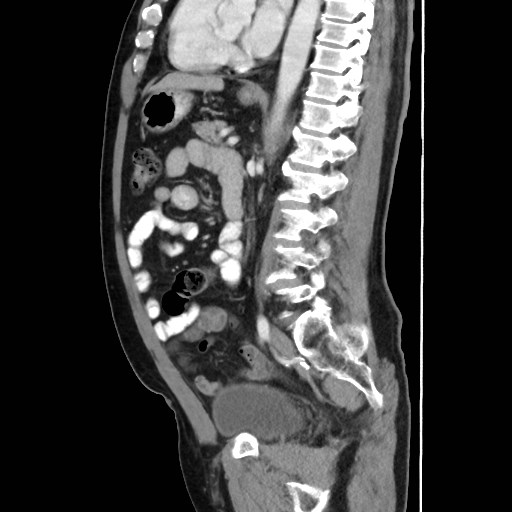Cecal mass causing appendicitis (Radiopaedia 59207-66531 C 38).jpg