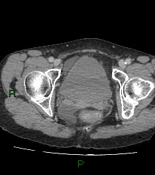 Cecal volvulus (Radiopaedia 86741-102900 A 127).jpg