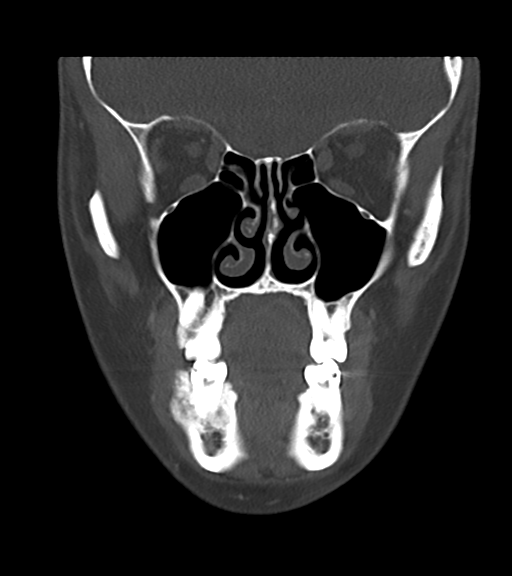 Cemento-ossifying fibroma (Radiopaedia 46243-50643 Coronal bone window 21).png