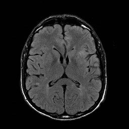File:Central-variant posterior reversible encephalopathy syndrome (PRES) (Radiopaedia 43880-47358 Axial FLAIR 13).jpg