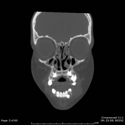 File:Central giant cell granuloma (Radiopaedia 45612-49754 Coronal bone window 3).jpg