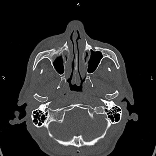 File:Central giant cell granuloma (Radiopaedia 83346-97761 Axial bone window 39).jpg