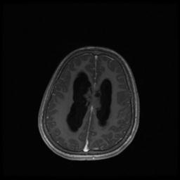 Central neurocytoma (Radiopaedia 30220-30842 Axial T1 C+ 108).jpg