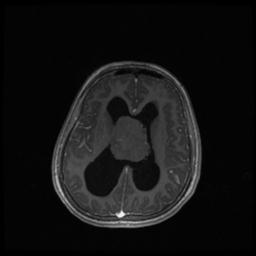 Central neurocytoma (Radiopaedia 30220-30842 Axial T1 C+ 91).jpg