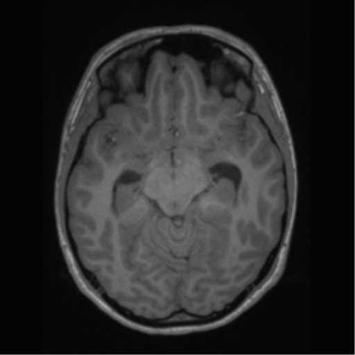 File:Central neurocytoma (Radiopaedia 37664-39557 Axial T1 29).png