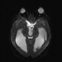 Central neurocytoma (Radiopaedia 56690-63469 Axial DWI 7).jpg