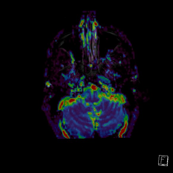 Central neurocytoma (Radiopaedia 84497-99872 Axial Perfusion 249).jpg
