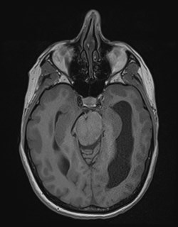 File:Central neurocytoma (Radiopaedia 84497-99872 Axial T1 78).jpg