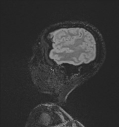 Central neurocytoma (Radiopaedia 84497-99872 Sagittal Flair + Gd 130).jpg